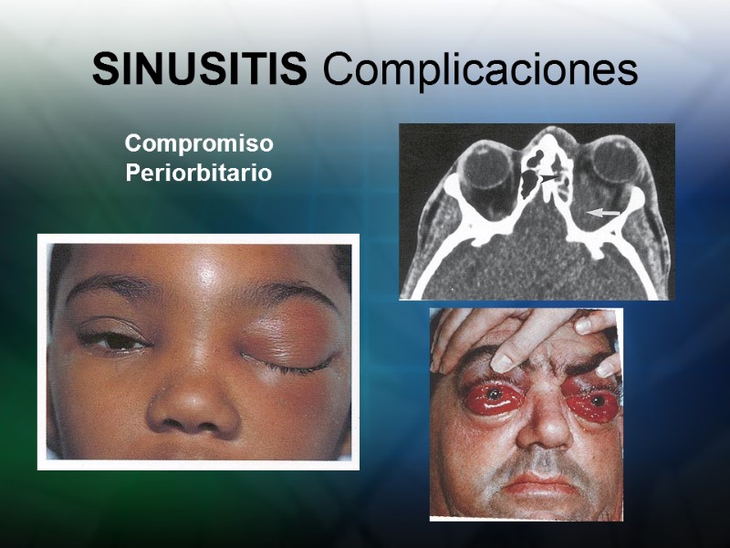 SINUSITIS Complicaciones Compromiso Periorbitario